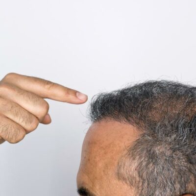 Hair transplant and its procedure