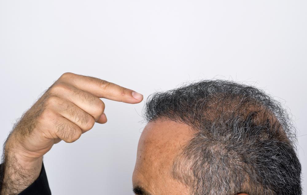Hair transplant and its procedure